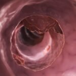 Perbedaan Tumor Jinak dan Ganas, dari Bentuk Hingga Gejala Klinisnya