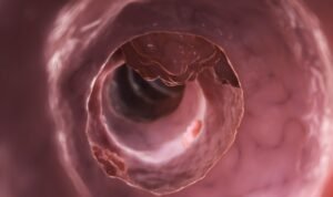 Perbedaan Tumor Jinak dan Ganas, dari Bentuk Hingga Gejala Klinisnya