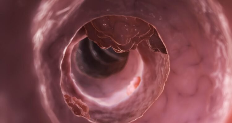 Perbedaan Tumor Jinak dan Ganas, dari Bentuk Hingga Gejala Klinisnya