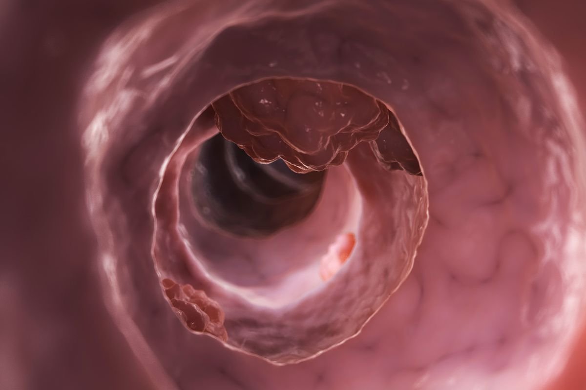 Perbedaan Tumor Jinak dan Ganas, dari Bentuk Hingga Gejala Klinisnya